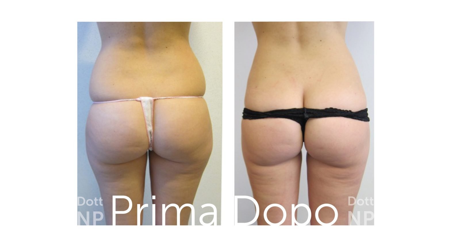 Liposuzione e Liposcultura